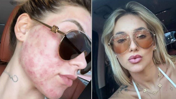 Virginia Fonseca assusta fãs ao aparecer com rosto vermelho; especialistas explicam caso – R7 Entretenimento